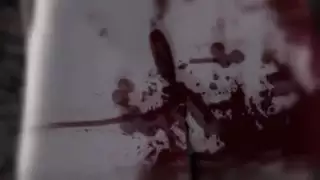 توسع الشرج بزوب ضخم